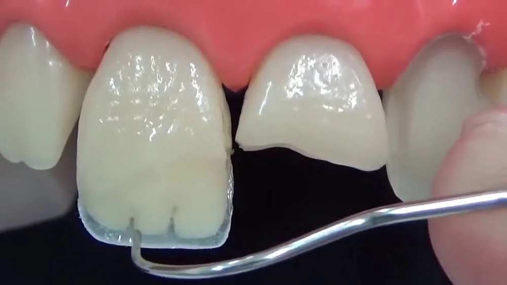 Коронки на зубы: какие бывают